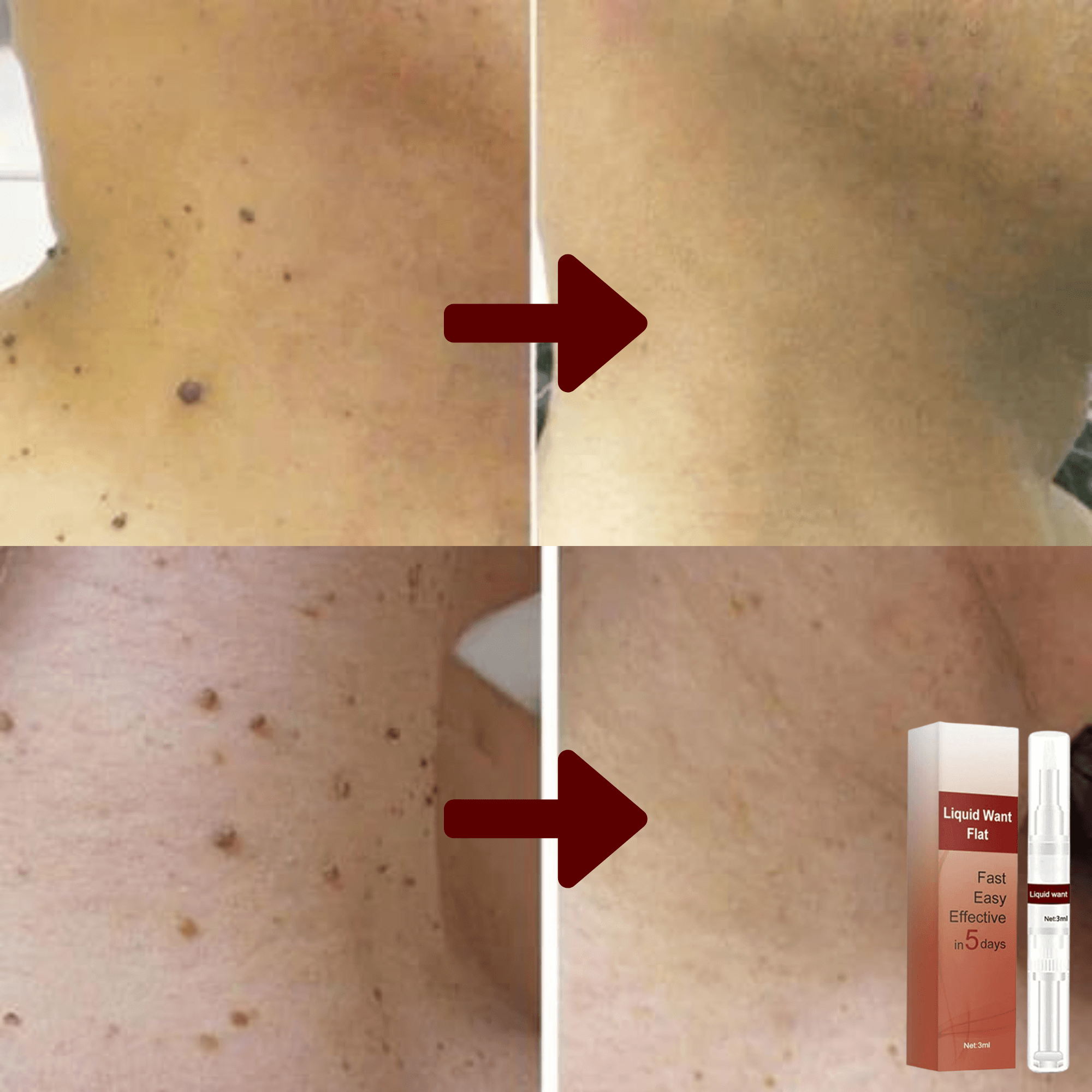 Huidlabels Verwijderaar