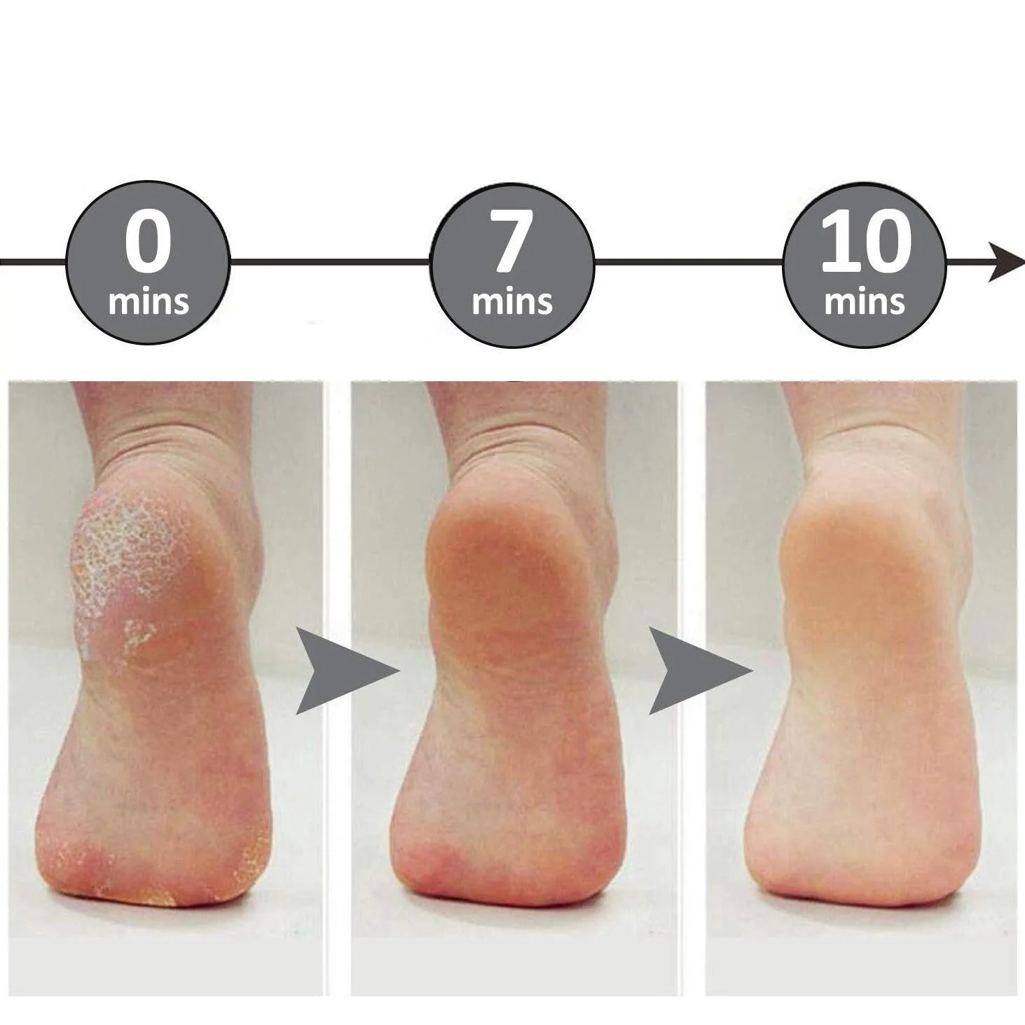 Professionele Voetvijl Eelt Verwijderaar