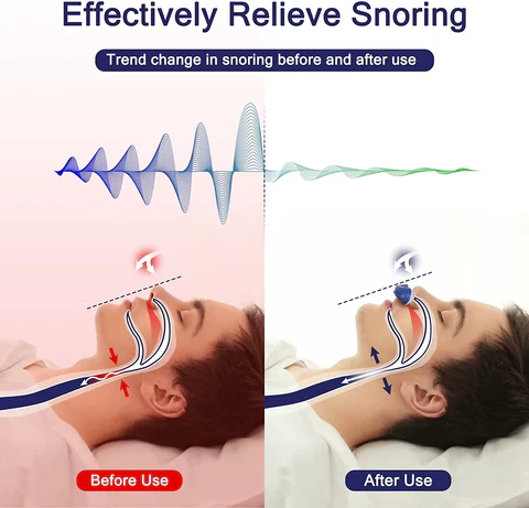 Micro CPAP Anti-Snurkapparaat voor Comfortabel Slapen 3