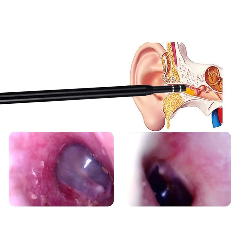 Live Ear Medicinale oor endoscoop.