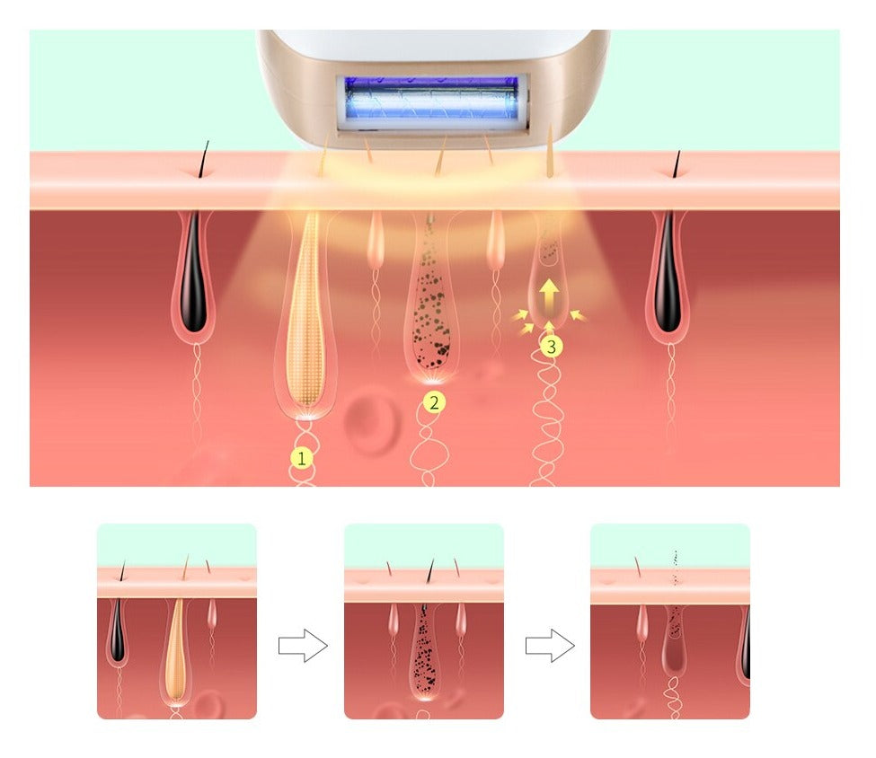 Permanent Ontharing Epilator